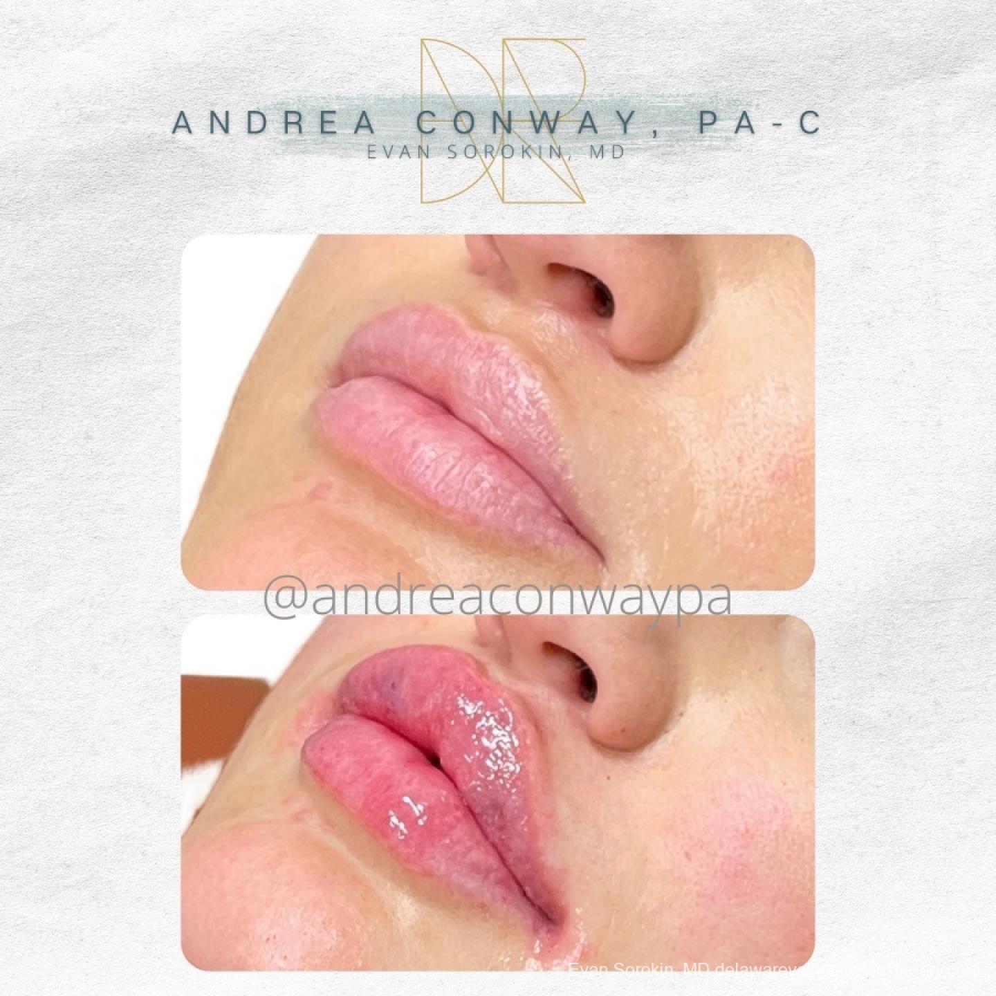 Lip Augmentation: Patient 50 - Before and After 3