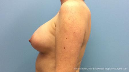 Philadelphia Breast Augmentation 13181 - After Image 5
