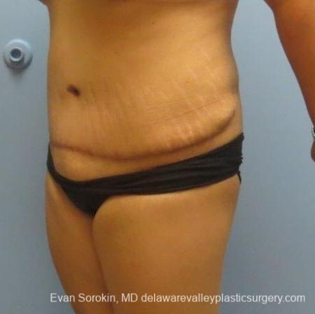 Philadelphia Abdominoplasty 8678 - After Image 3