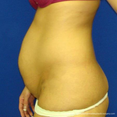 Philadelphia Abdominoplasty 9475 - Before and After Image 5