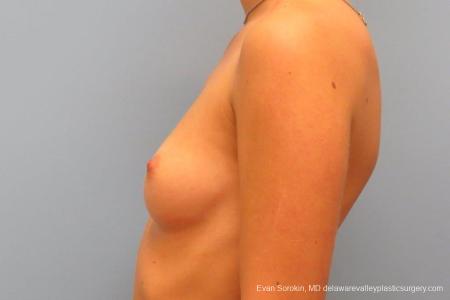 Philadelphia Breast Augmentation 8666 - Before and After Image 5