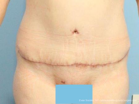 Philadelphia Abdominoplasty 9467 - After Image 1
