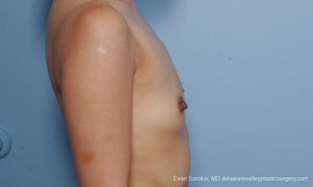 Philadelphia Breast Augmentation 8661 - Before Image 4