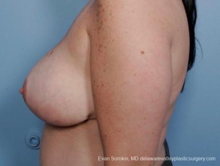 Philadelphia Breast Reduction 8703 - After Image 4