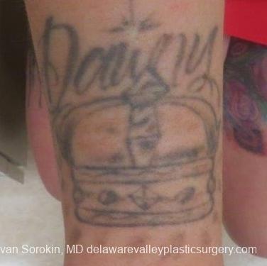 Philadelphia Tattoo Removal 8647 - Before Image 1