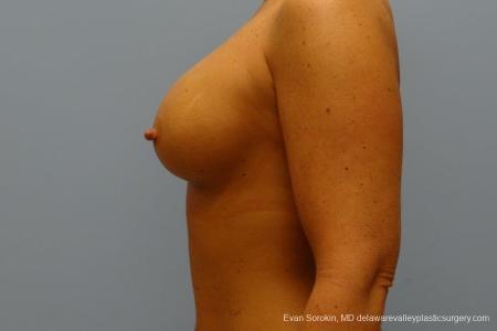 Philadelphia Breast Augmentation 8774 - After Image 5