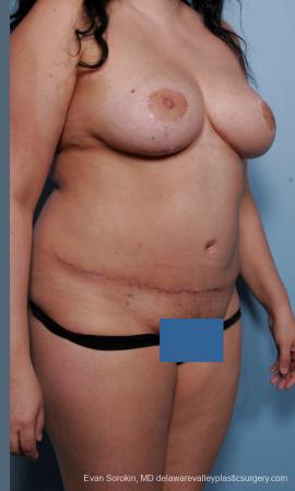 Philadelphia Mommy Makeover 9442 - After Image 2