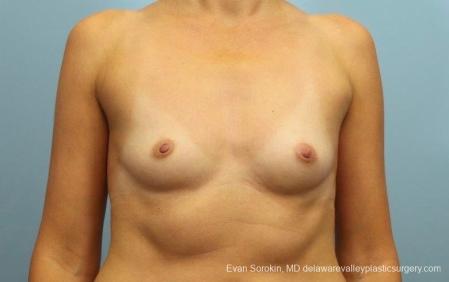 Philadelphia Breast Augmentation 8764 - Before Image 1