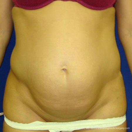 Philadelphia Abdominoplasty 9475 - Before Image 1