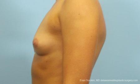 Philadelphia Breast Augmentation 9183 - Before and After Image 5