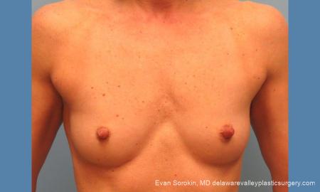 Philadelphia Breast Augmentation 9744 - Before Image 1