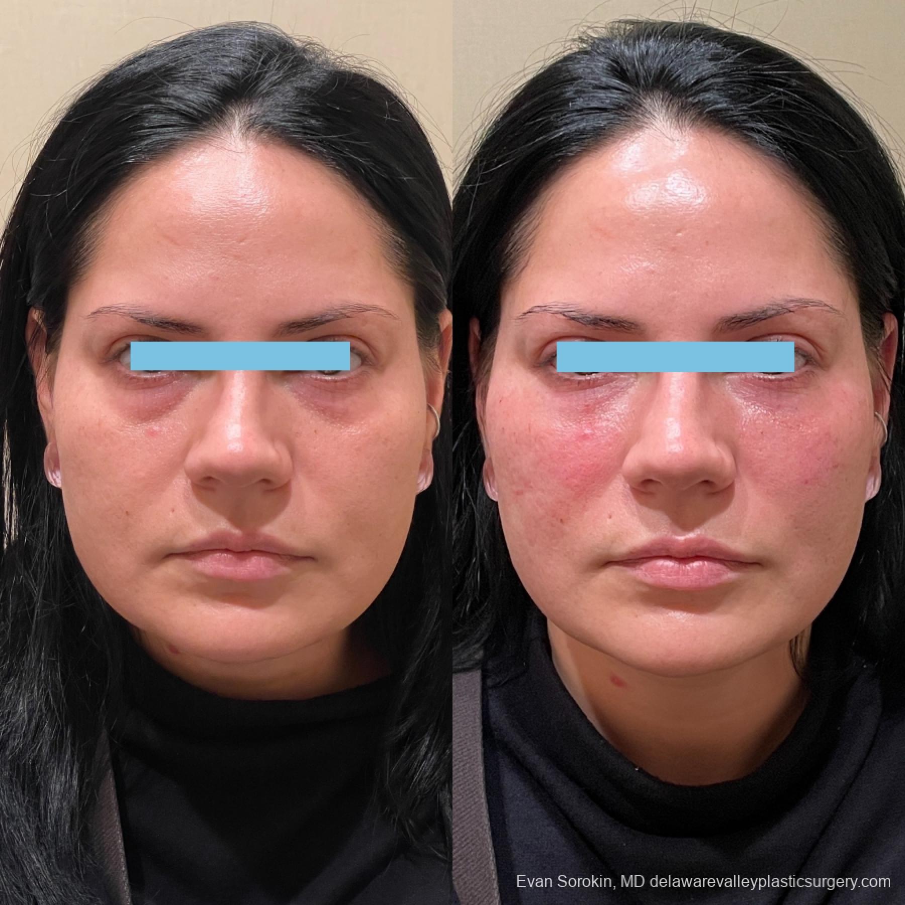 Fillers: Patient 19 - Before and After 