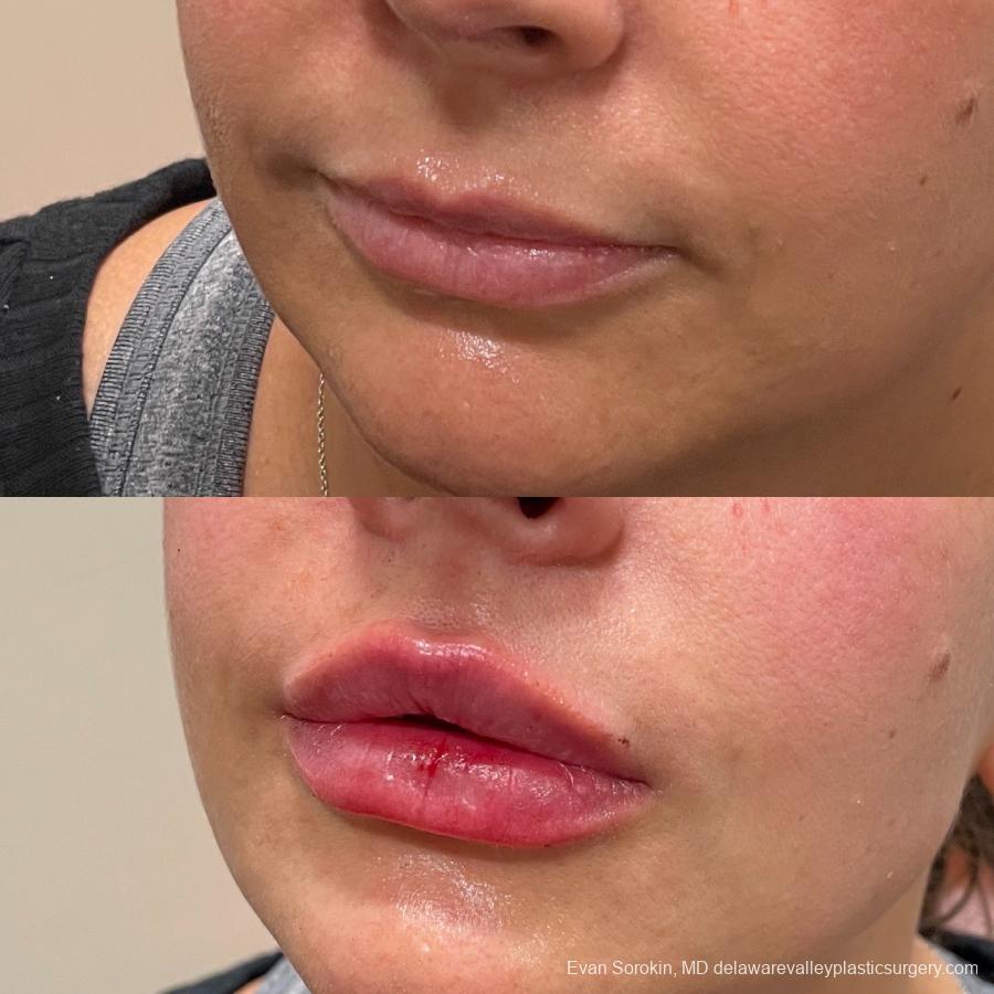 Lip Filler: Patient 18 - Before and After 3