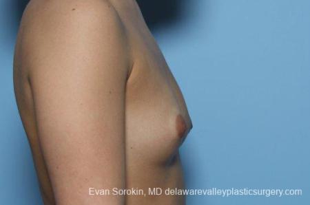 Philadelphia Breast Augmentation 8773 - Before Image 4