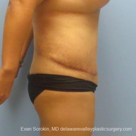 Philadelphia Abdominoplasty 8678 - After Image 5
