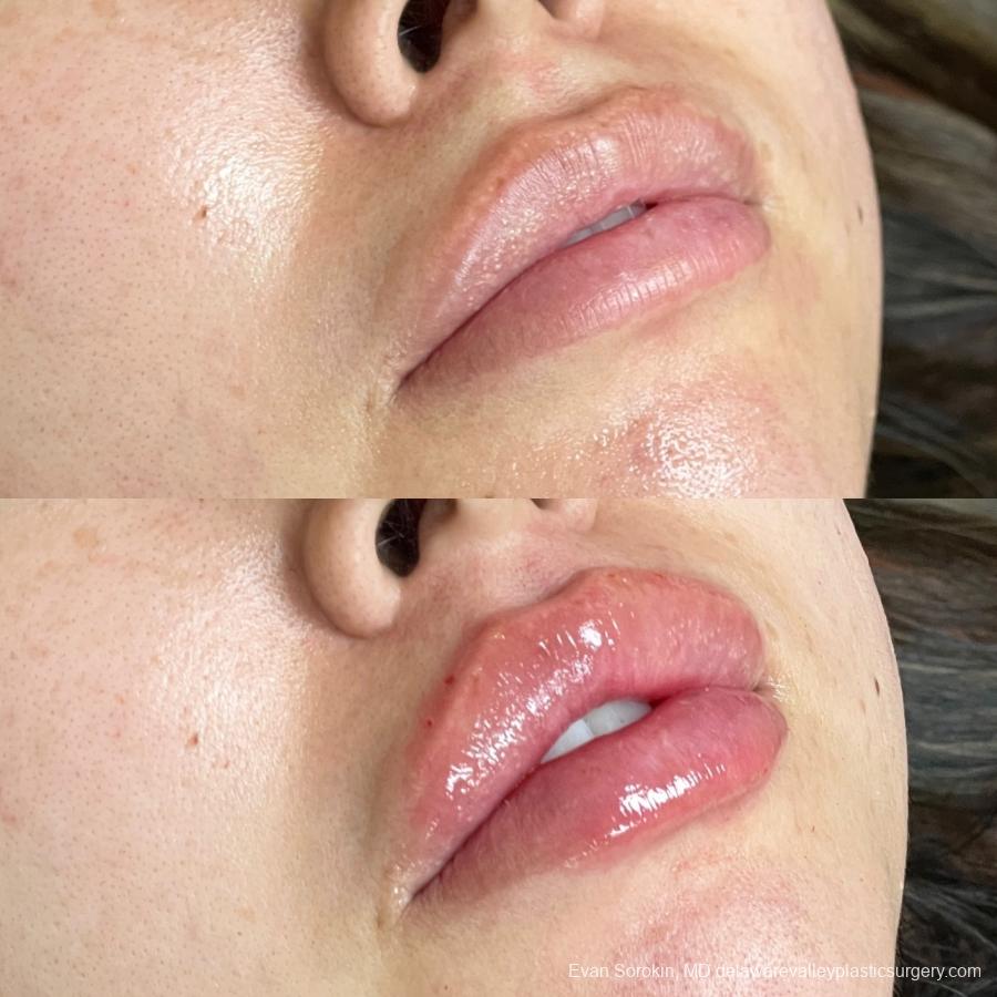 Lip Filler: Patient 24 - Before and After 2