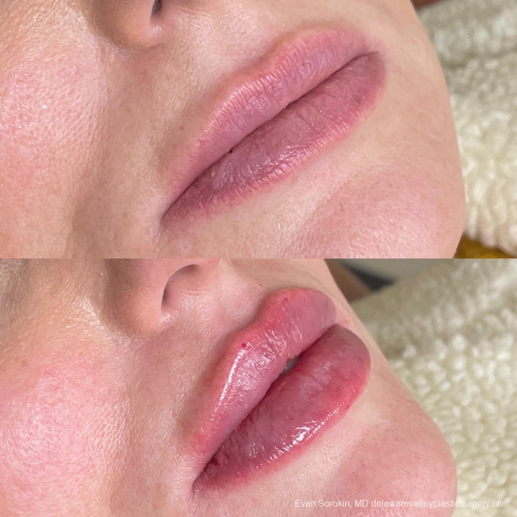Lip Augmentation: Patient 61 - Before and After 2