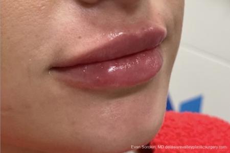 Lip Augmentation: Patient 9 - After Image 1
