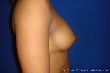 Philadelphia Breast Augmentation 8665 - After Image 4