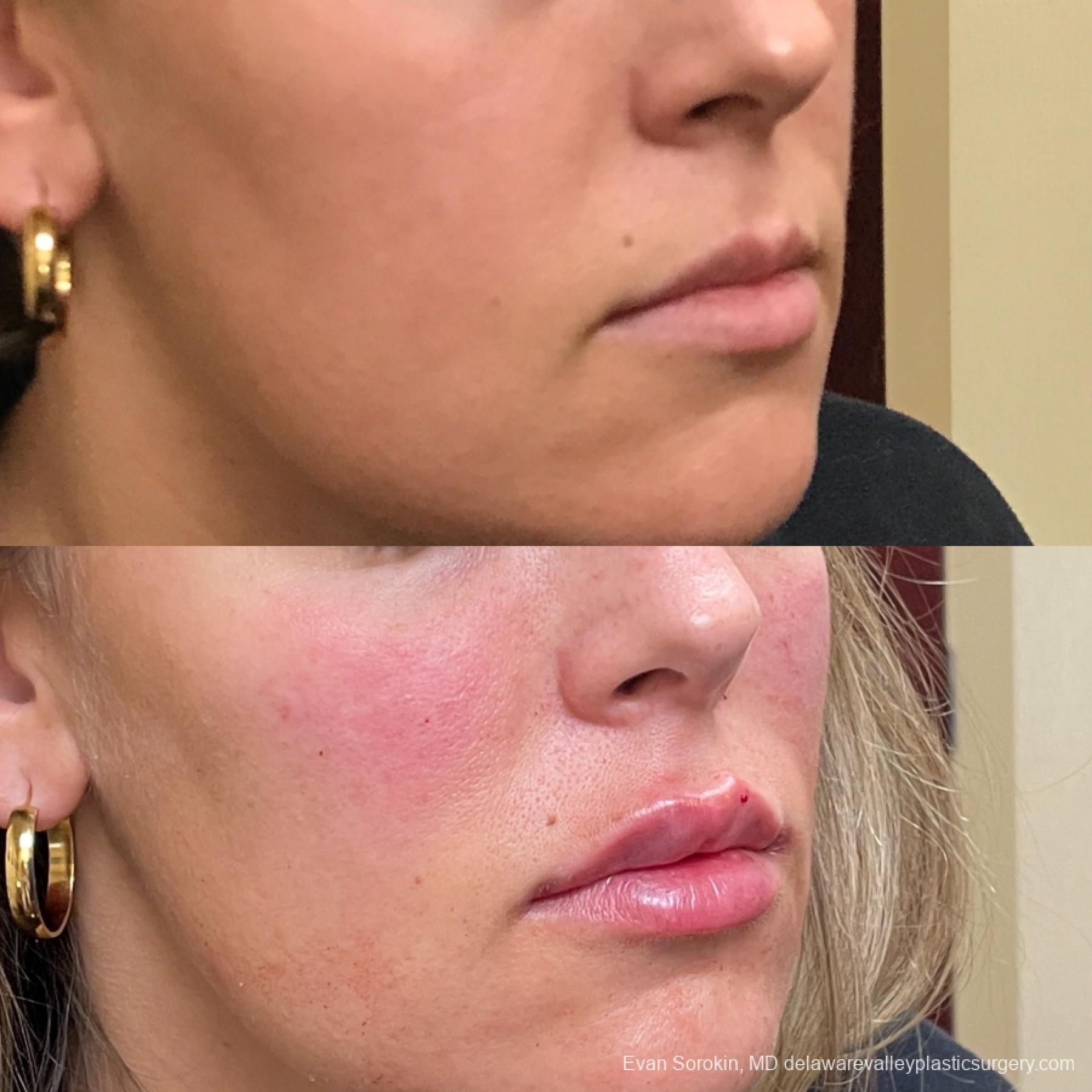 Lip Augmentation: Patient 28 - Before and After 2