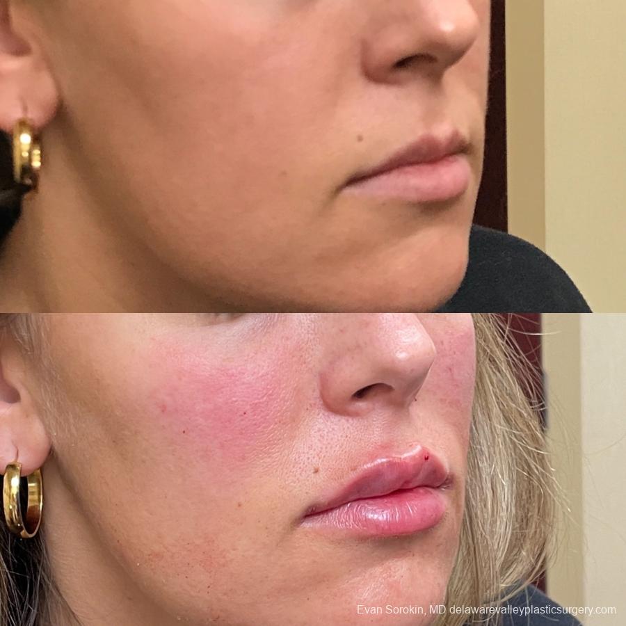Lip Augmentation: Patient 28 - Before and After 2