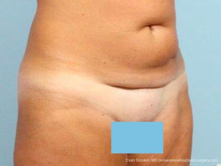 Philadelphia Abdominoplasty 9464 - Before Image 2