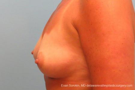 Philadelphia Breast Augmentation 9406 - Before and After Image 5