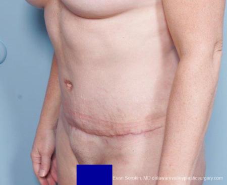Philadelphia Abdominoplasty 9315 - After Image 2