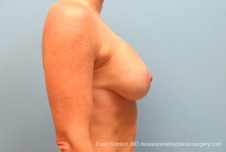 Philadelphia Breast Lift and Augmentation 8690 - After Image 4