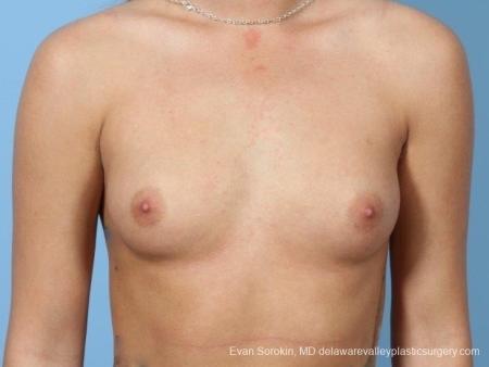 Philadelphia Breast Augmentation 8657 - Before Image 1