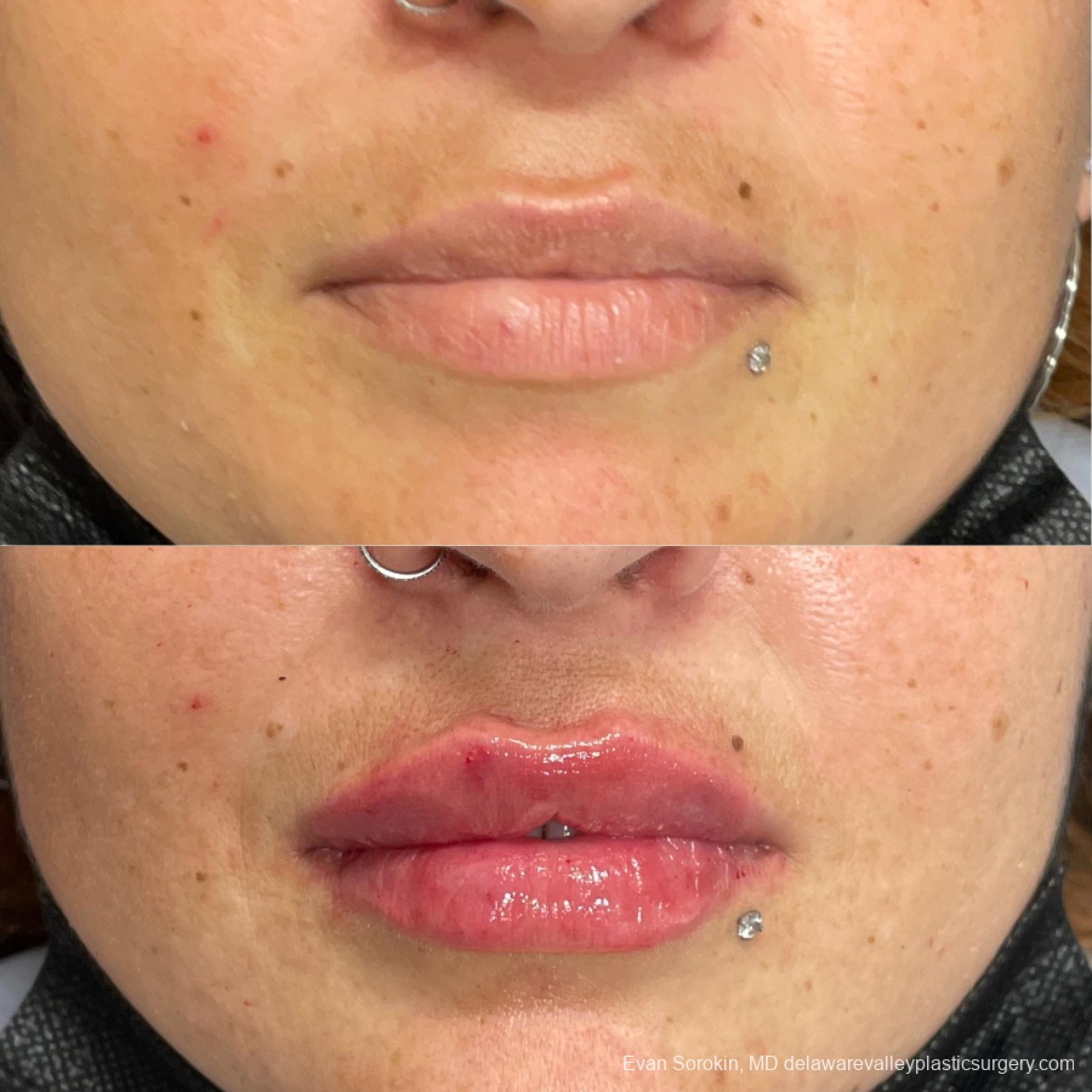 Lip Augmentation: Patient 21 - Before and After 