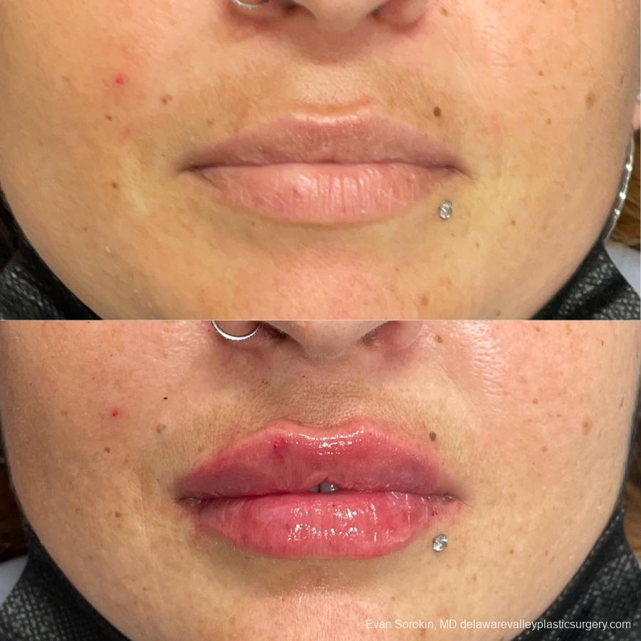 Lip Augmentation: Patient 21 - Before and After 1