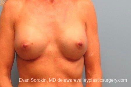 Philadelphia Breast Augmentation 8770 - After Image 1