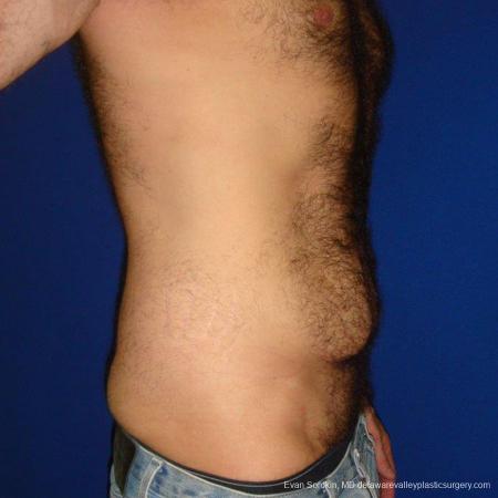Philadelphia Abdominoplasty 9468 - Before Image 3