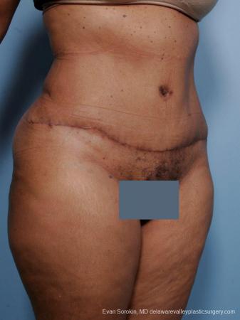 Philadelphia Abdominoplasty 9461 - After Image 2