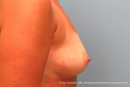 Philadelphia Breast Augmentation 9406 - Before Image 3