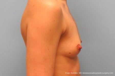 Philadelphia Breast Augmentation 8763 - Before Image 4