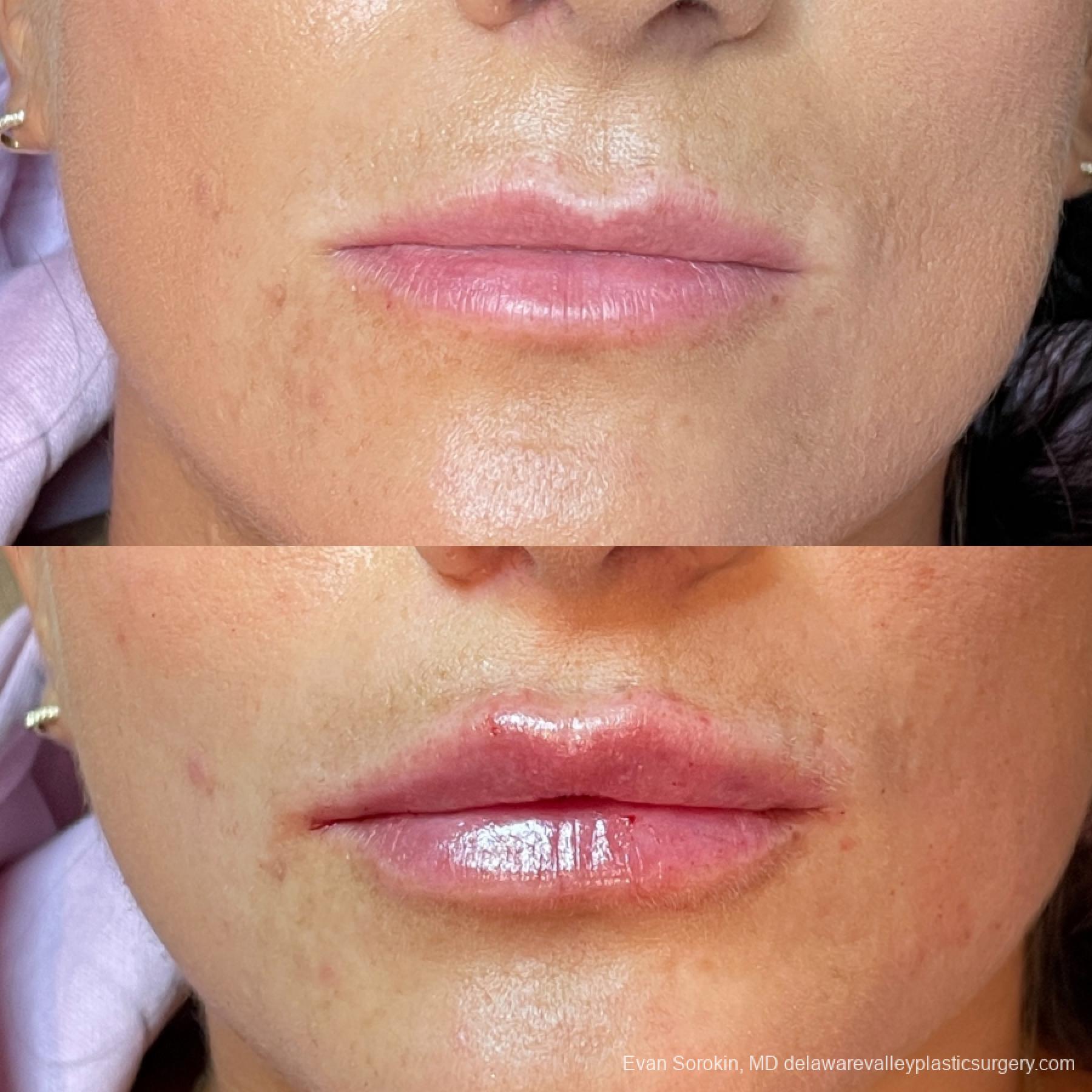 Lip Augmentation: Patient 6 - Before and After  