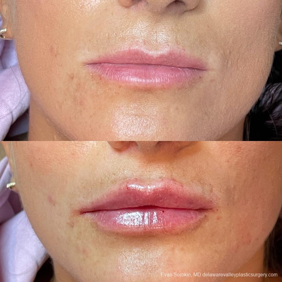 Lip Augmentation: Patient 6 - Before and After  