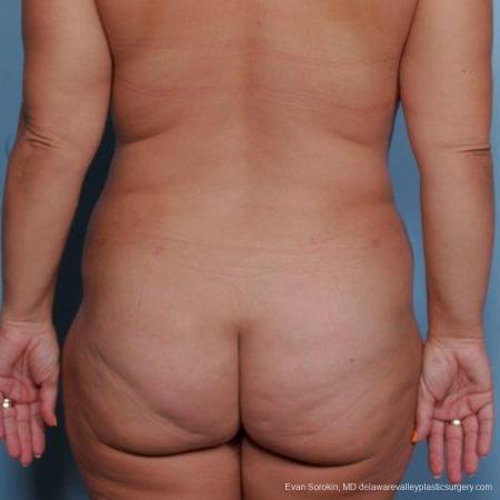 Philadelphia Liposuction 9481 - After Image 4