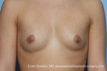 Philadelphia Breast Augmentation 8773 - Before Image 1