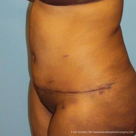 Philadelphia Abdominoplasty 9472 - After Image 4