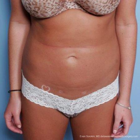 Philadelphia Liposuction 9483 - After Image 1