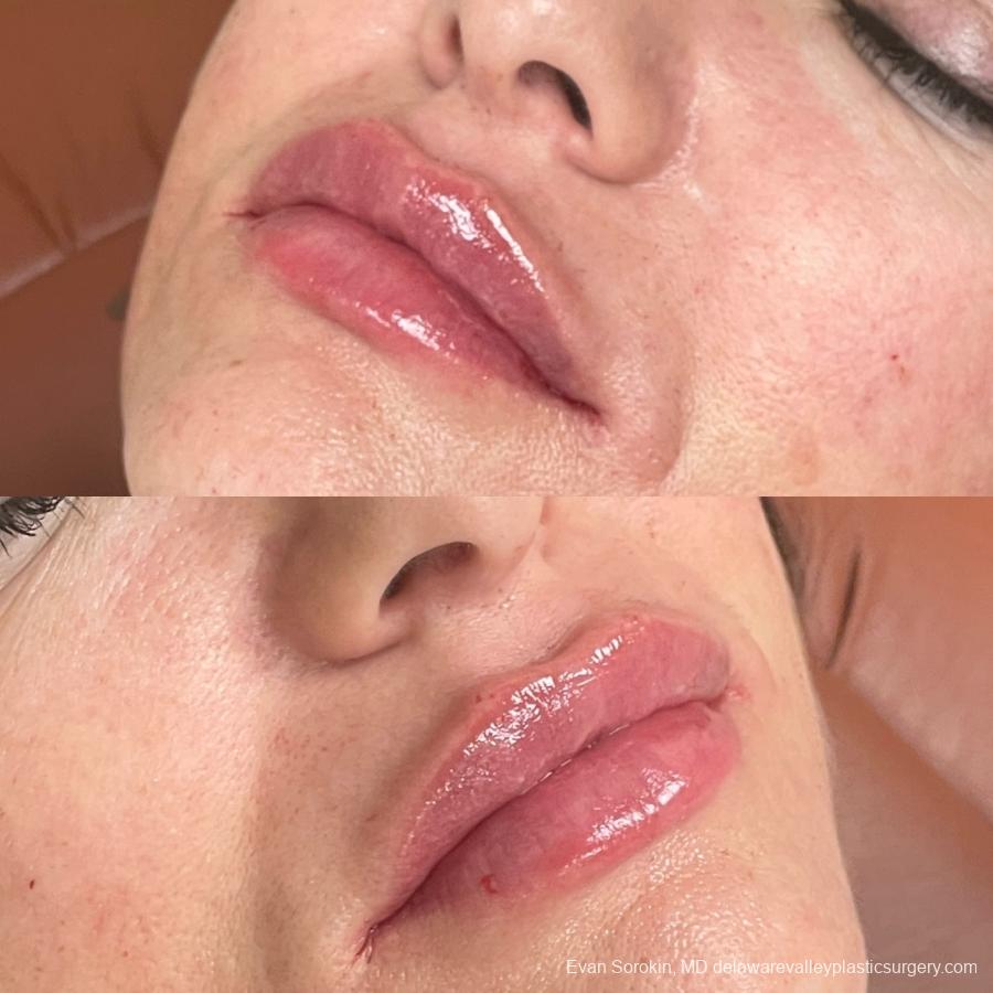 Lip Filler: Patient 22 - Before and After 1
