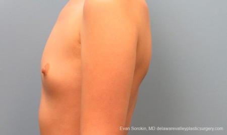 Philadelphia Breast Augmentation 10113 - Before and After Image 5