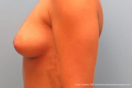 Philadelphia Breast Augmentation 9344 - Before and After Image 5