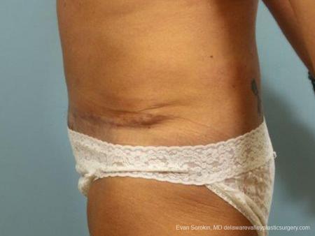 Philadelphia Abdominoplasty 9464 - After Image 5