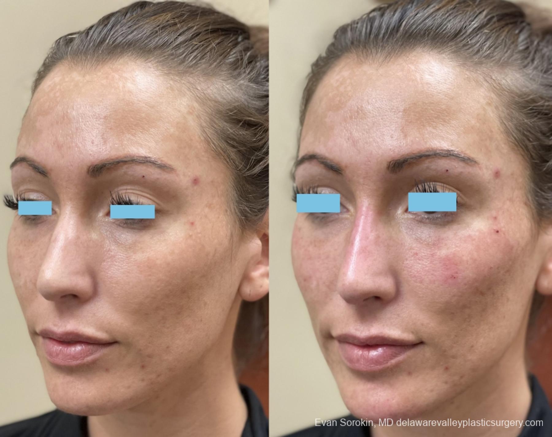 Fillers: Patient 12 - Before and After 3