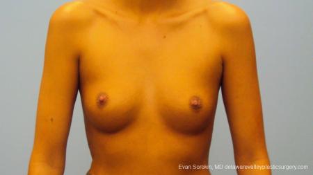 Philadelphia Breast Augmentation 9292 - Before Image 1
