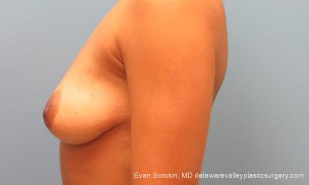 Philadelphia Breast Lift and Augmentation 10119 - Before and After Image 5